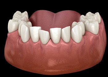 Illustration of crowded teeth