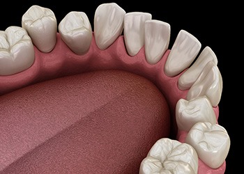 Illustration of gapped teeth