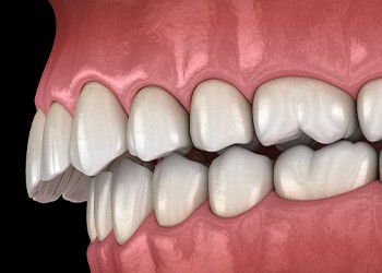 Illustration of an overbite