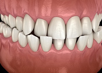 Illustration of a crossbite