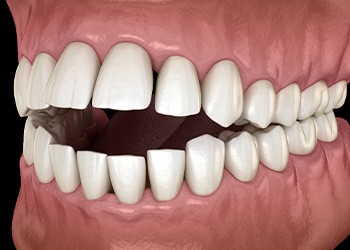Illustration of an open bite