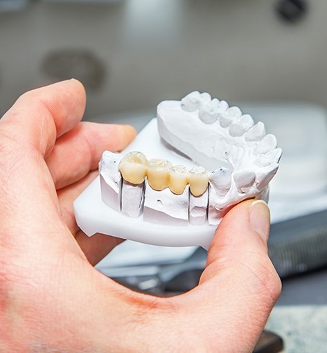A model comparing traditional and implant-supported dental bridges in Hayward