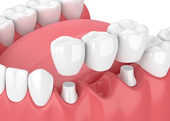 Illustration of traditional dental bridge