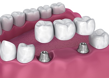 Illustration of implant dental bridge