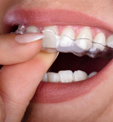 Close-up of person’s mouth as they use clear aligner