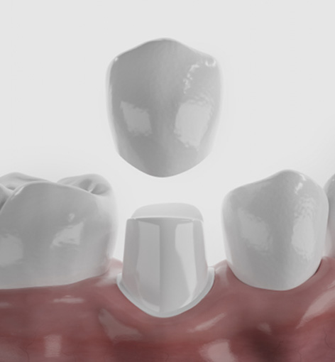 Digital image of a dental crown being placed over tooth
