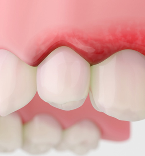 Up-close view of red and swollen gum tissue 