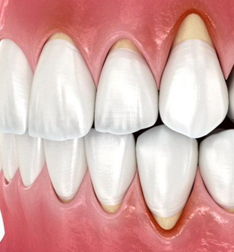 Digital view of gum recession 