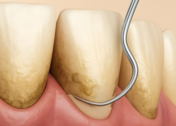 Digital view of scaling and root planing 