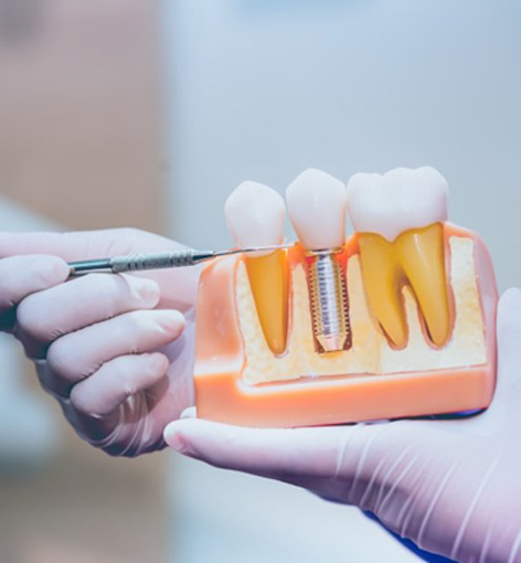 Dentist holding a model dental implant and pointing to it