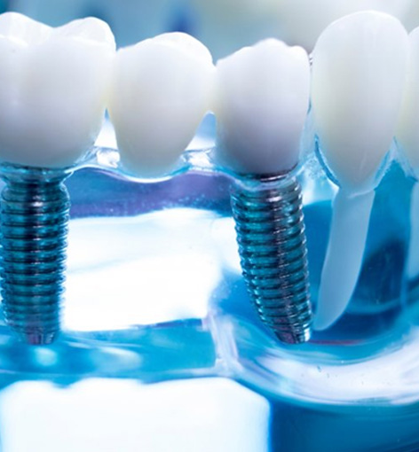 Close up of dental implants in a transparent display stand