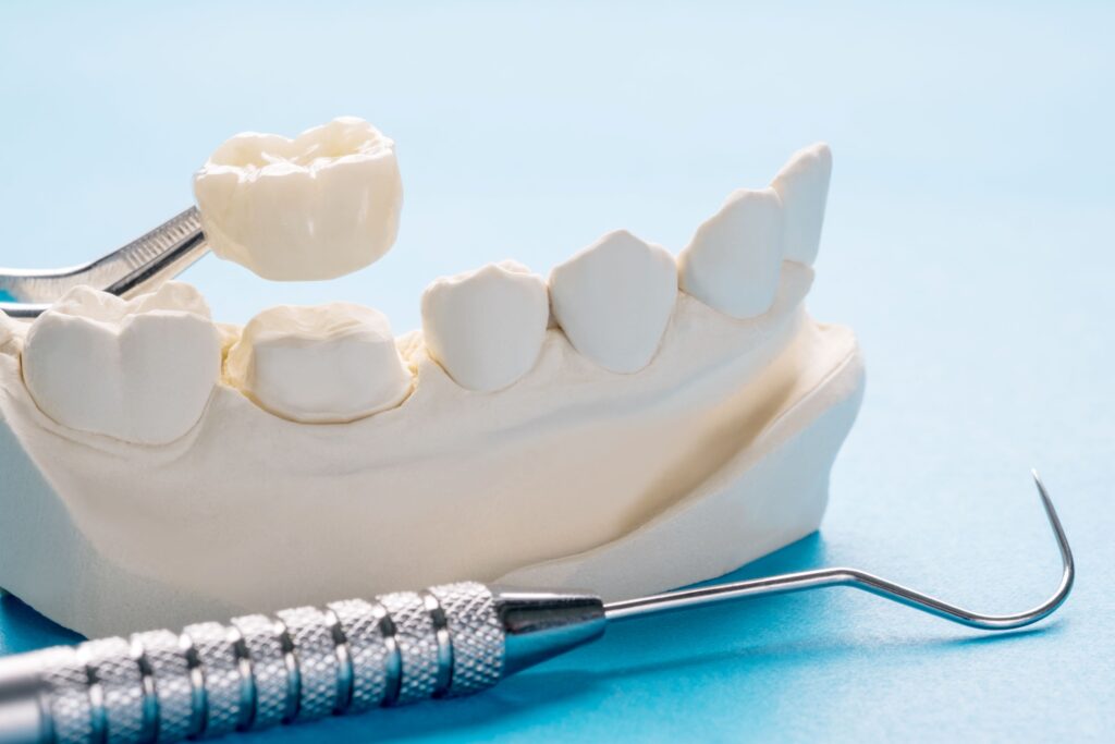 Dental crown being placed on model lower jaw with light blue background